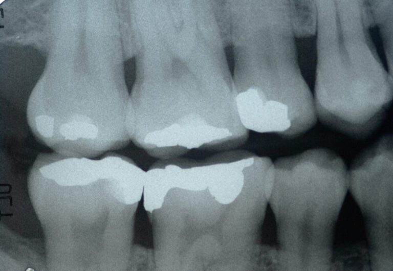 Why Does the EPA Require Amalgam Separators in Dental Clinics? Hazardous Waste Experts